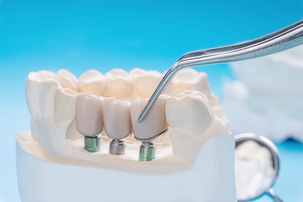 une prothèse dentaire conçue par un denturologiste du complexe santé boucherville de la rive-sud